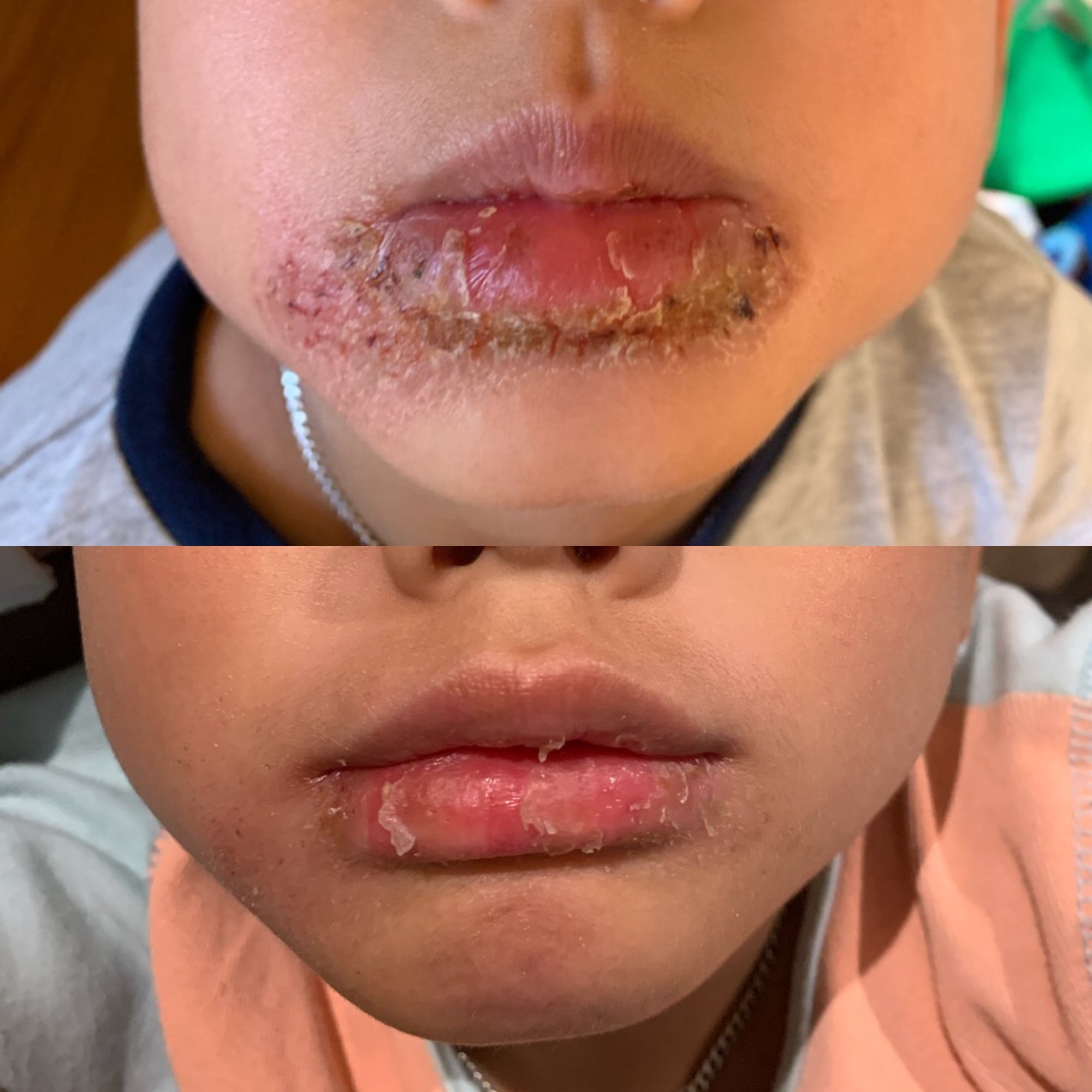 eczema cream australia 2023