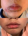 eczema cream australia 2023