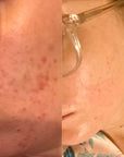 best acne skincare australia 2024