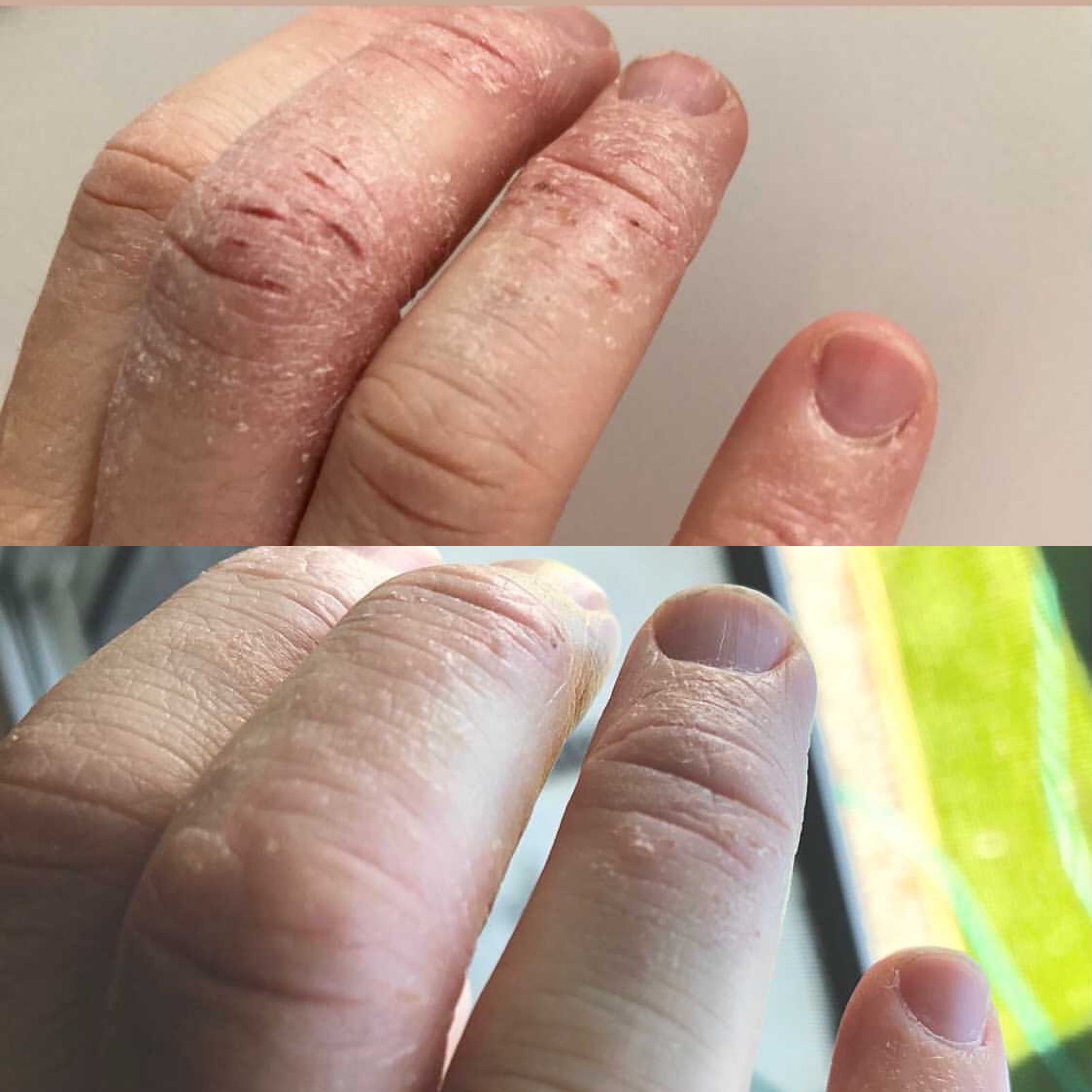 ezcema cream for hands