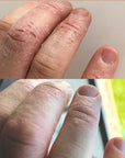 ezcema cream for hands