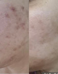 acne scar products