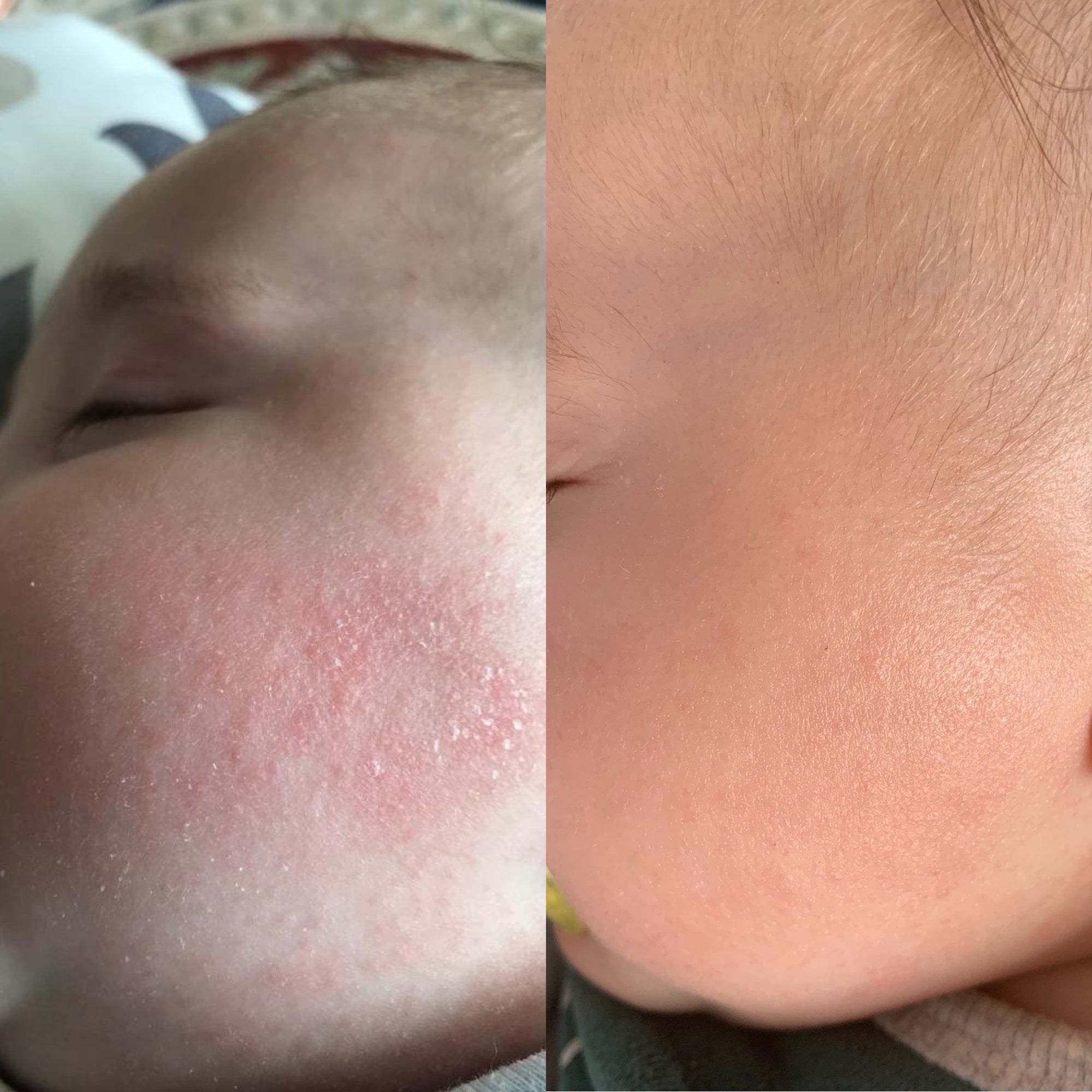 best eczema cream australia