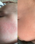best eczema cream australia