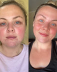 best products for acne