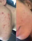 best face oil for acne australia