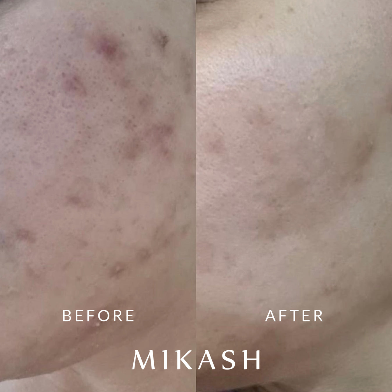 Mikaash Mikash Skincare Results