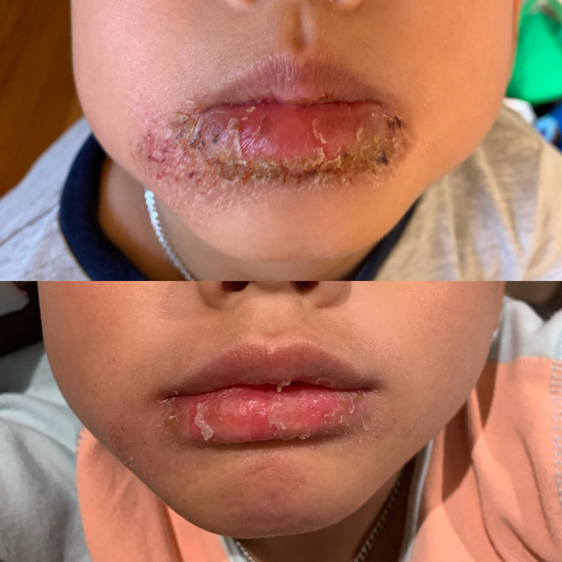 eczema cream australia 2023
