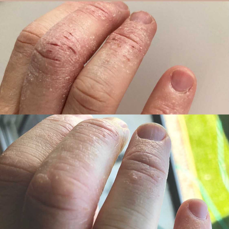 ezcema cream for hands 