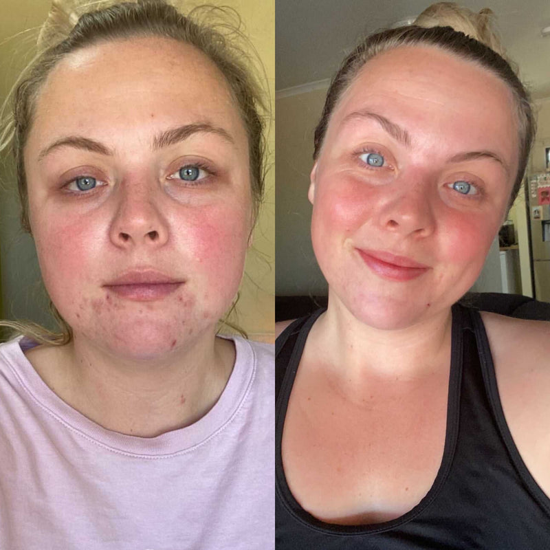 best products for acne